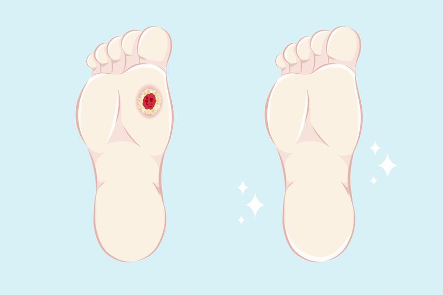 Diabetic Foot Ulcers