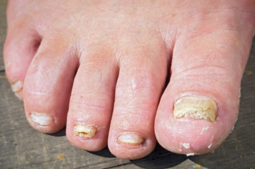nail fungal infection